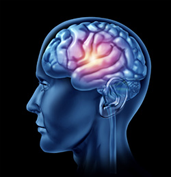 Brain Aneurysm in Toluca Lake, CA